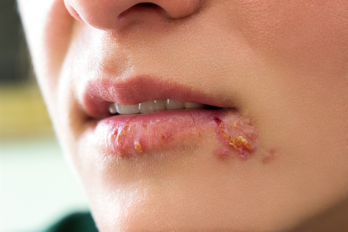 herpes-simplex-virusu-hsv.jpg