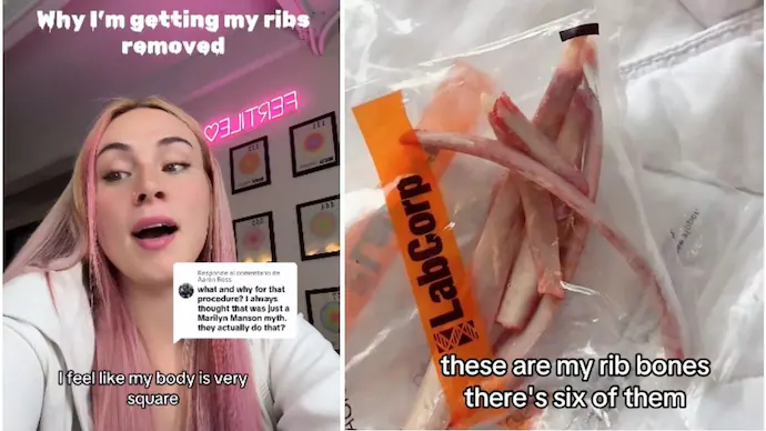 a-us-based-influencer-plans-to-make-a-crown-from-her-removed-rib-bones-113717539-16x9-0.webp