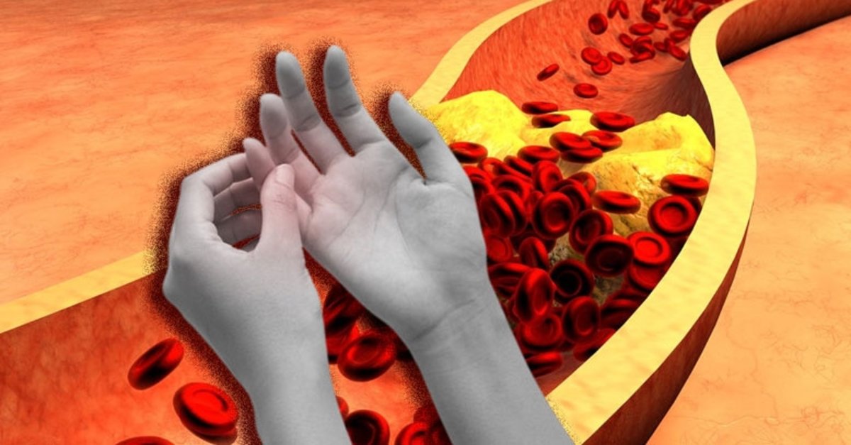 1200x627-kolesterol-belirtileri-kolesterolun-parmaklarla-olan-ilgisi-ne-iste-o-gercek-1645624693507.jpg