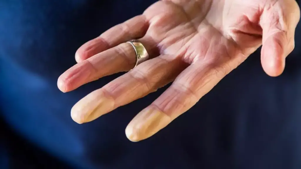 soguk-havalarda-raynaud-hastaligina-dikkat-raynaud-sendromu-belirtileri-ve-tedavisi-nedir-1702622321-001-1024x576.webp