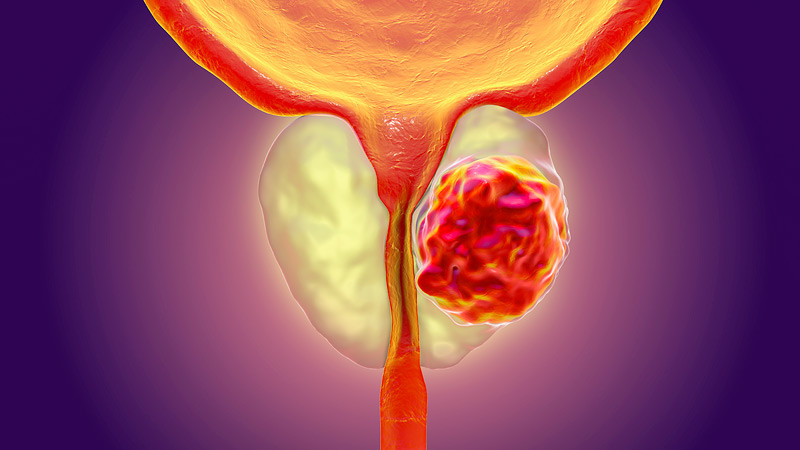 prostat-kanserinin-nedenleri-nelerdir.jpg