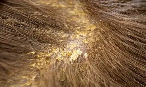 what-is-dandruff-and-how-to-get-rid-of-it-min5-1-jpg.webp